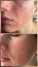 Miracletox Angelto Cream