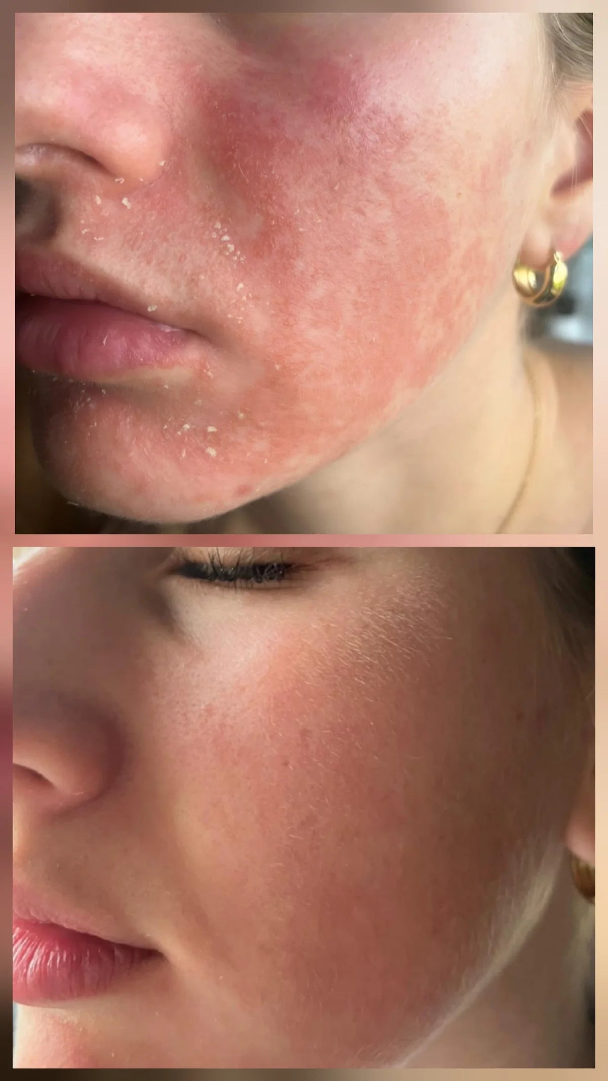 Miracletox Angelto Cream